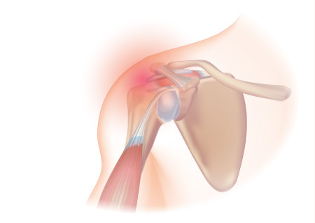 There are many reasons for shoulder pain