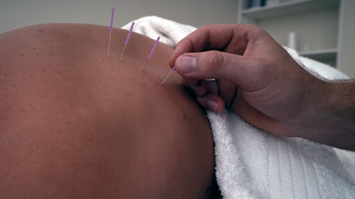 Dry needling is one of the techniques at MYOTHERAPY BRUNSWICK