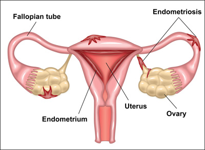 Endometriosis is when tissue that’s similar to the uterus lining starts growing on the outside of the uterus