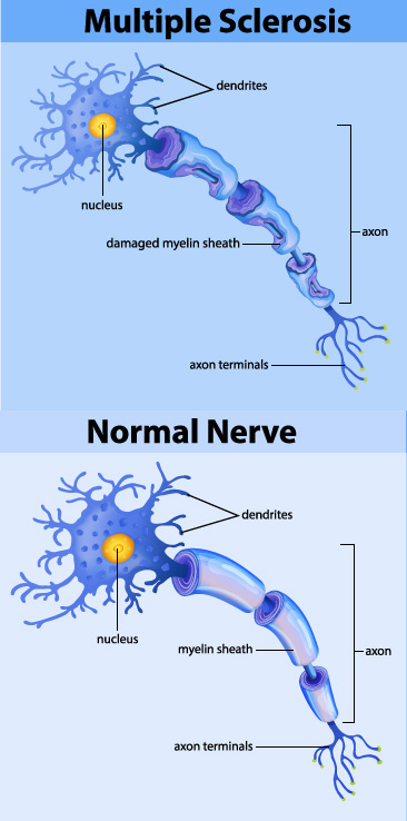 The immune system to attack the central nervous system, which is the brain, spinal cord and optic nerves