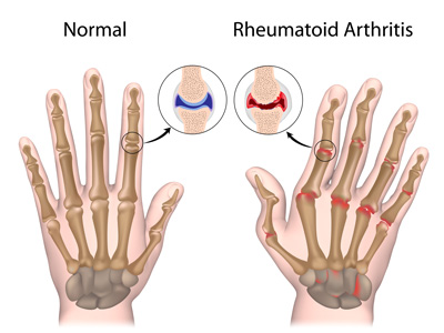 Rheumatoid arthritis is an autoimmune condition that is experienced as chronic inflammation in at least 5 synovial joints.