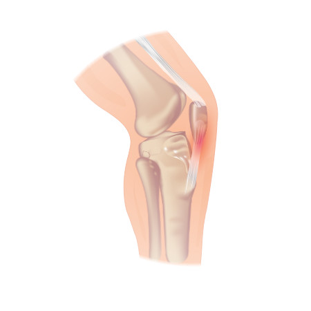 Our therapists can perform specialist testing to help determine the source of your knee pain