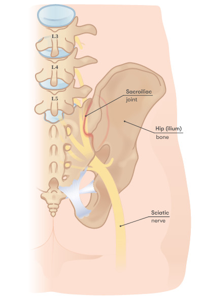 Read more about sciatic pain